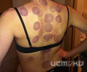 Баночный массаж - что это Баночный массаж - что это