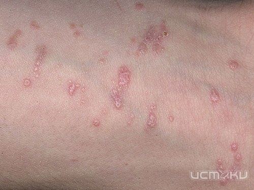 Лишаем в Орловской области стали болеть чаще Лишаем в Орловской области стали болеть чаще