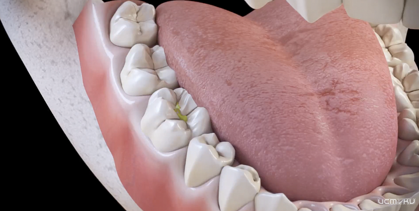 Что нужно знать о пульпите, чтобы сохранить здоровье зубов Что нужно знать о пульпите, чтобы сохранить здоровье зубов