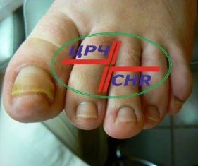 Лечение вросшего ногтя