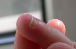 В Ливенском районе один ребенок лишился фаланги пальца, а у другого в руках взорвался опрыскиватель