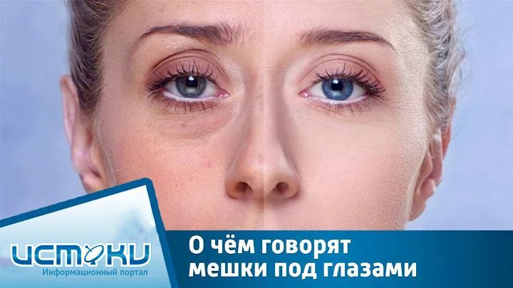 Как убрать малярные мешки?