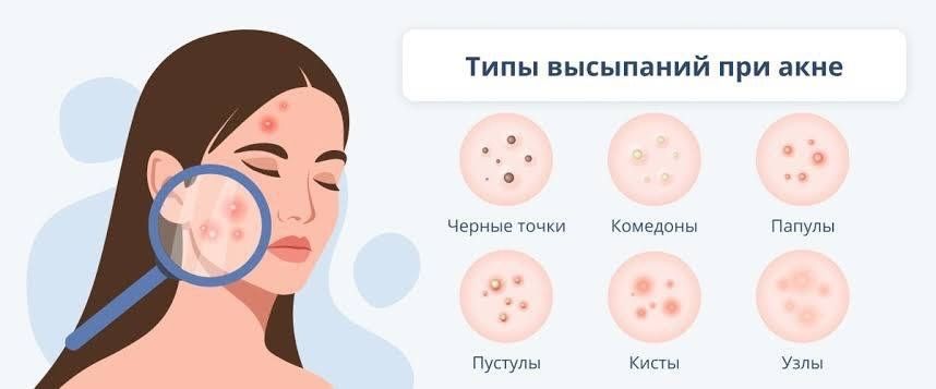 Средства для кожи от прыщей : правильный уход за проблемной кожей - выбор средств от акне и воспален