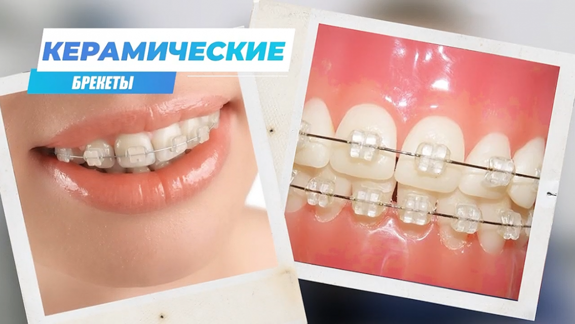 Стоматология. Керамические брекеты