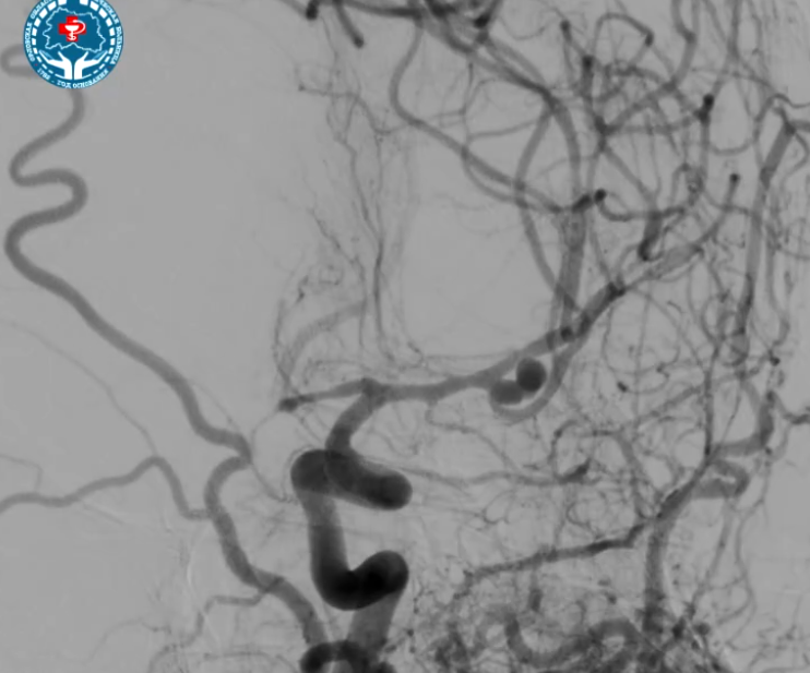 Орловские врачи провели сложнейшую операцию на мозге и спасли пациента