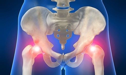 Восстановительный период после эндопротезирования тазобедренного сустава