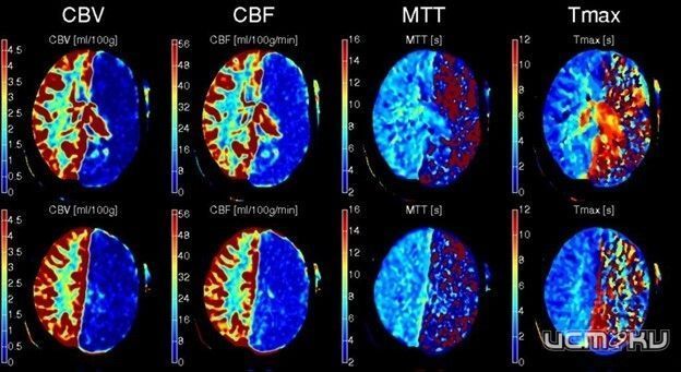 Орловские врачи спасли пациента с ишемических инсультом