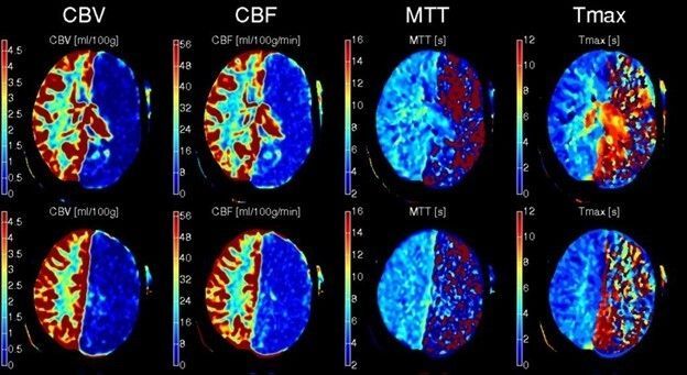 Орловские врачи спасли пациента с ишемических инсультом