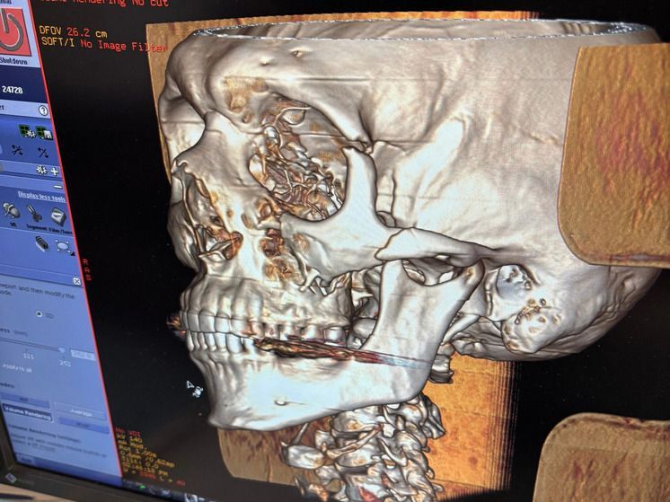 Орловские врачи спасли лицо пострадавшего в ДТП мужчины