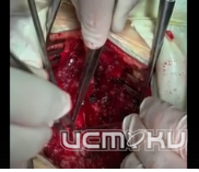 В Орловской областной клинической больнице провели сложнейшую операцию 