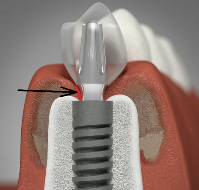 Имплантация зубов
