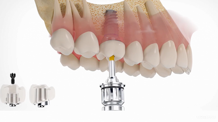 Как происходит базальная имплантация зубов?
