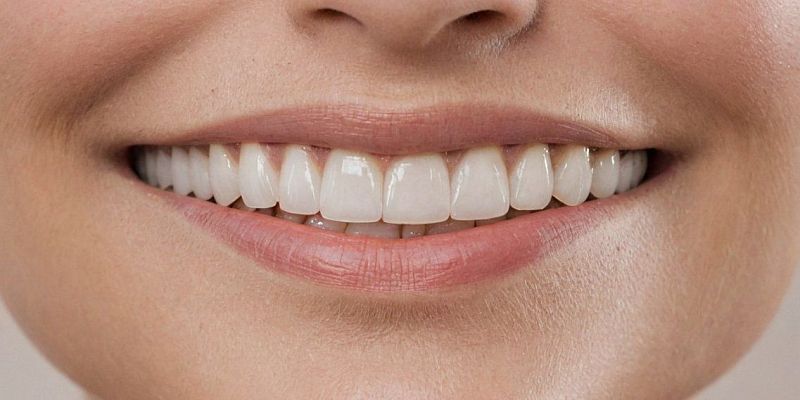 Что такое люминиры и почему они стали революцией в эстетической стоматологии