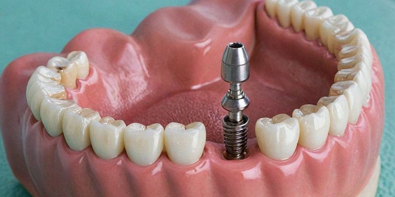 Как выбрать стоматолога для имплантации зубов?