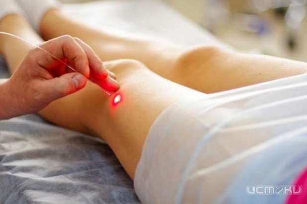 Как убрать вены на ногах лазером?