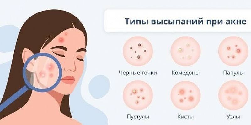 Средства для кожи от прыщей : правильный уход за проблемной кожей - выбор средств от акне и воспален