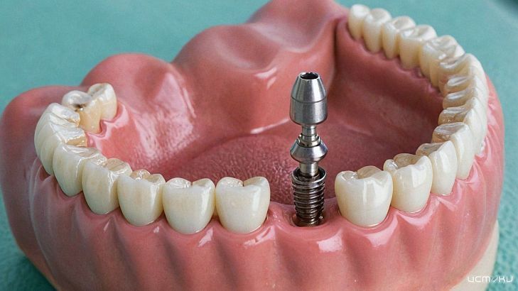 Как выбрать стоматолога для имплантации зубов?
