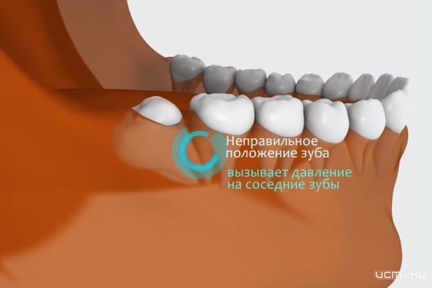 Зубы мудрости. Что это такое и когда они вылезают?