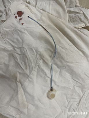 Орловчанка несколько лет прожила с инородным предметом в сердце