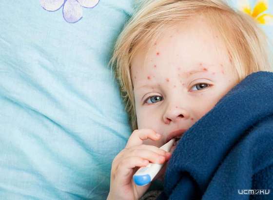 В Орловской области лабораторно подтверждены 7 случаев заболевания корью