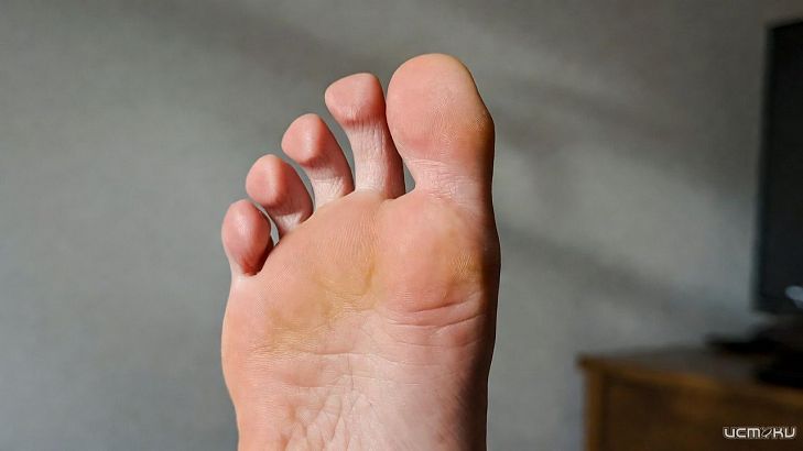 Можно ли вылечить «косточку на ноге» без операции