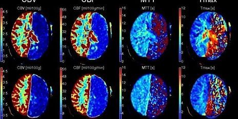 Орловские врачи спасли пациента с ишемических инсультом
