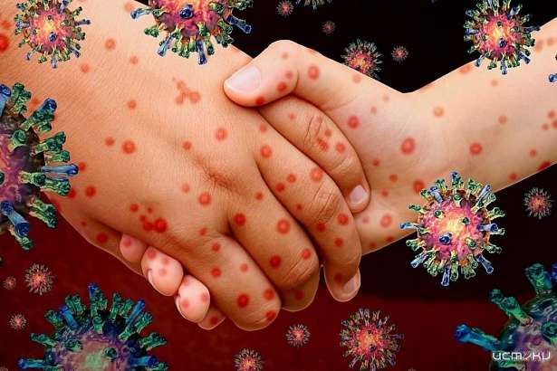 Один случай заболевания корью подтвердился в Орловской области