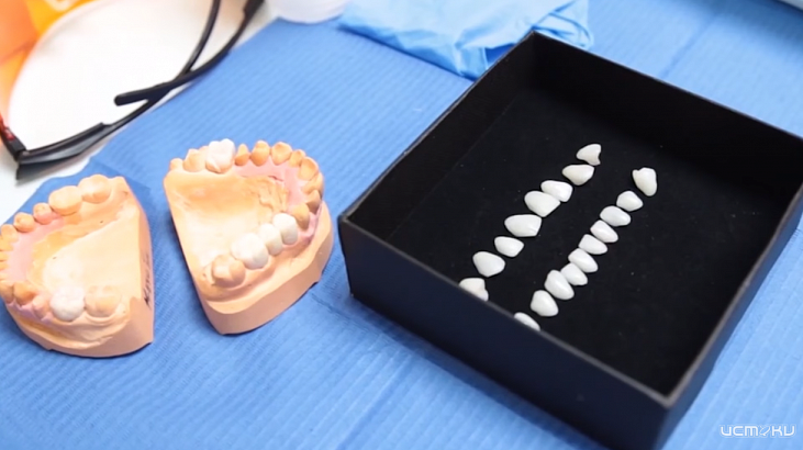 Виниры на зубы. Преимущества